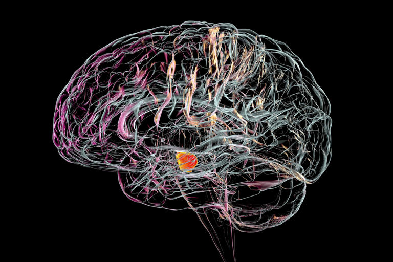 is slurred speech a neurological disorder