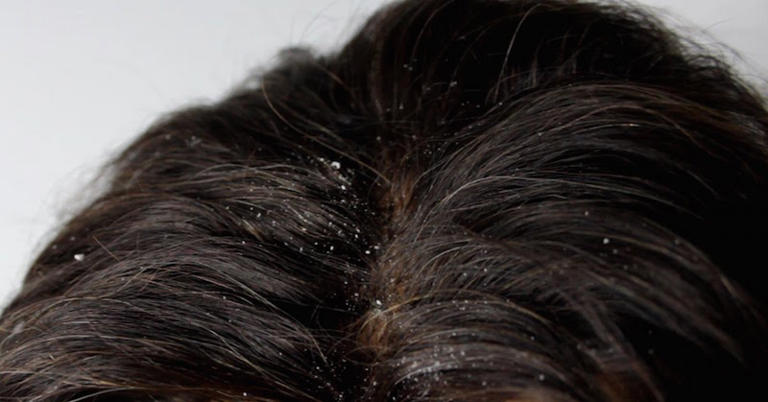 6 Home Remedies For Dandruff And Itchy Scalp