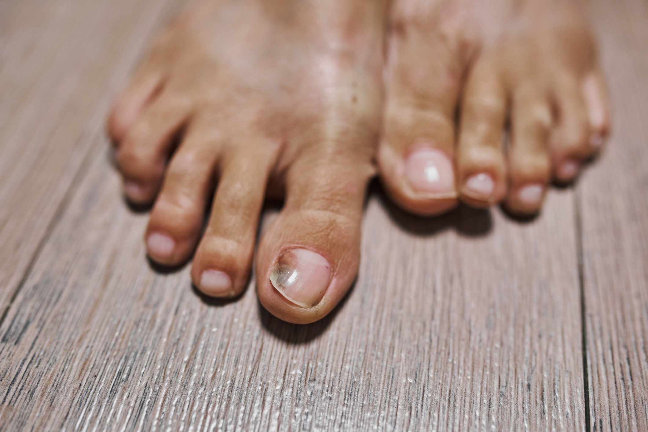 what is a bruised toenail?