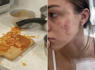 Student still has scars two years after being burned by exploding spaghetti<br><br>