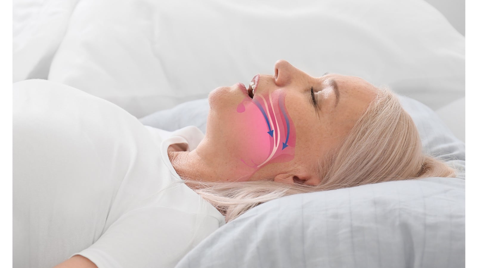 <p>Snoring results from obstructed airways during sleep. Common causes include poor muscle tone in the throat, excessive throat tissue, or an elongated soft palate or uvula.</p> <p>It can also indicate underlying health issues such as nasal congestion from sinus infections or allergies, nasal polyps, or a deviated septum.</p>