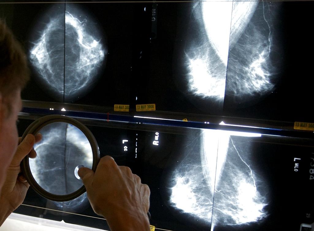 begin breast cancer screening at age 40, canadian cancer society urges