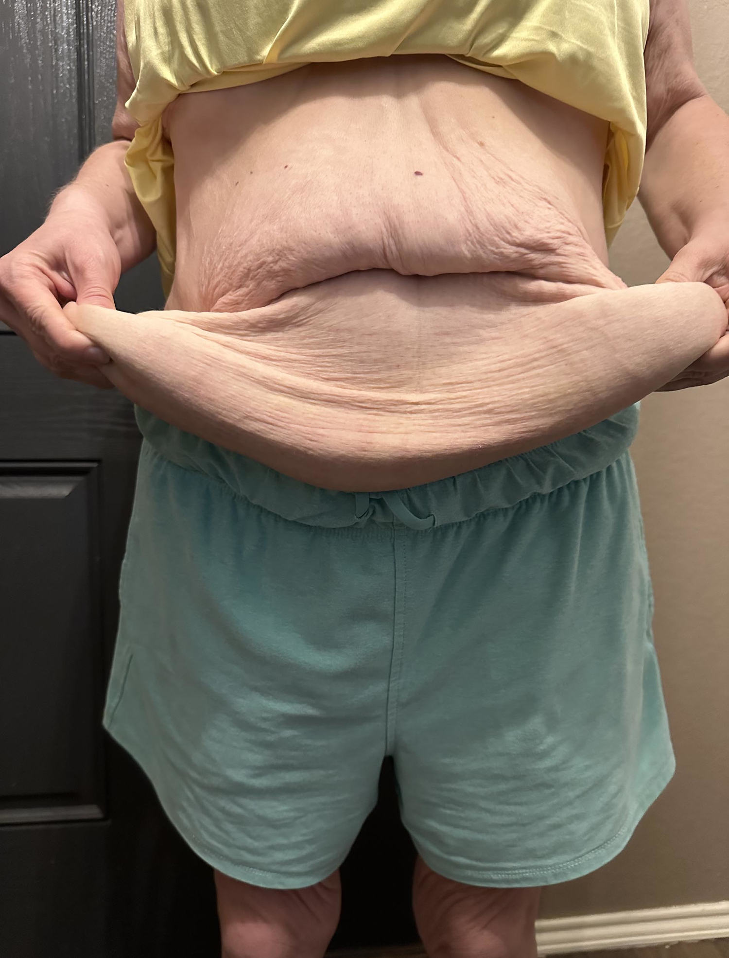after losing 210 lbs with walking and a low-carb diet, 1 mom has 4 pounds of skin removed