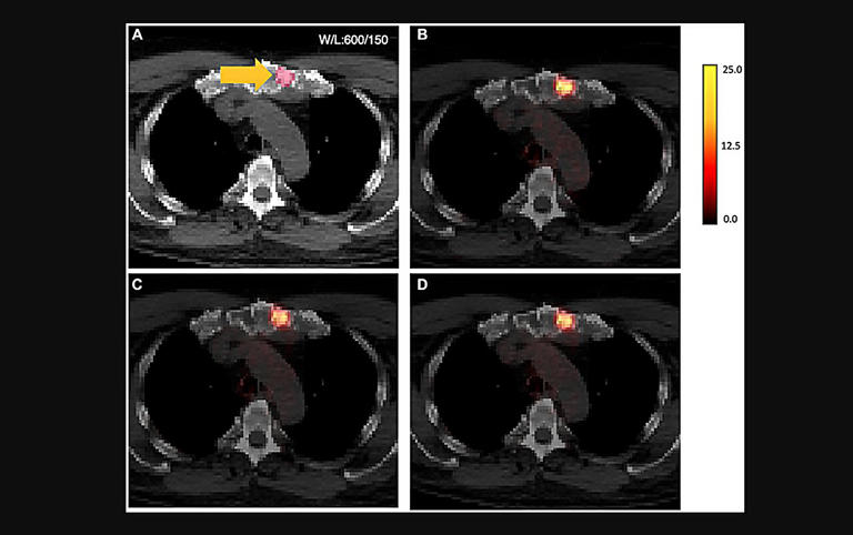 AI-generated PET results shown overlaid on CT. Credit: Oncotarget (2024). DOI: 10.18632/oncotarget.28583