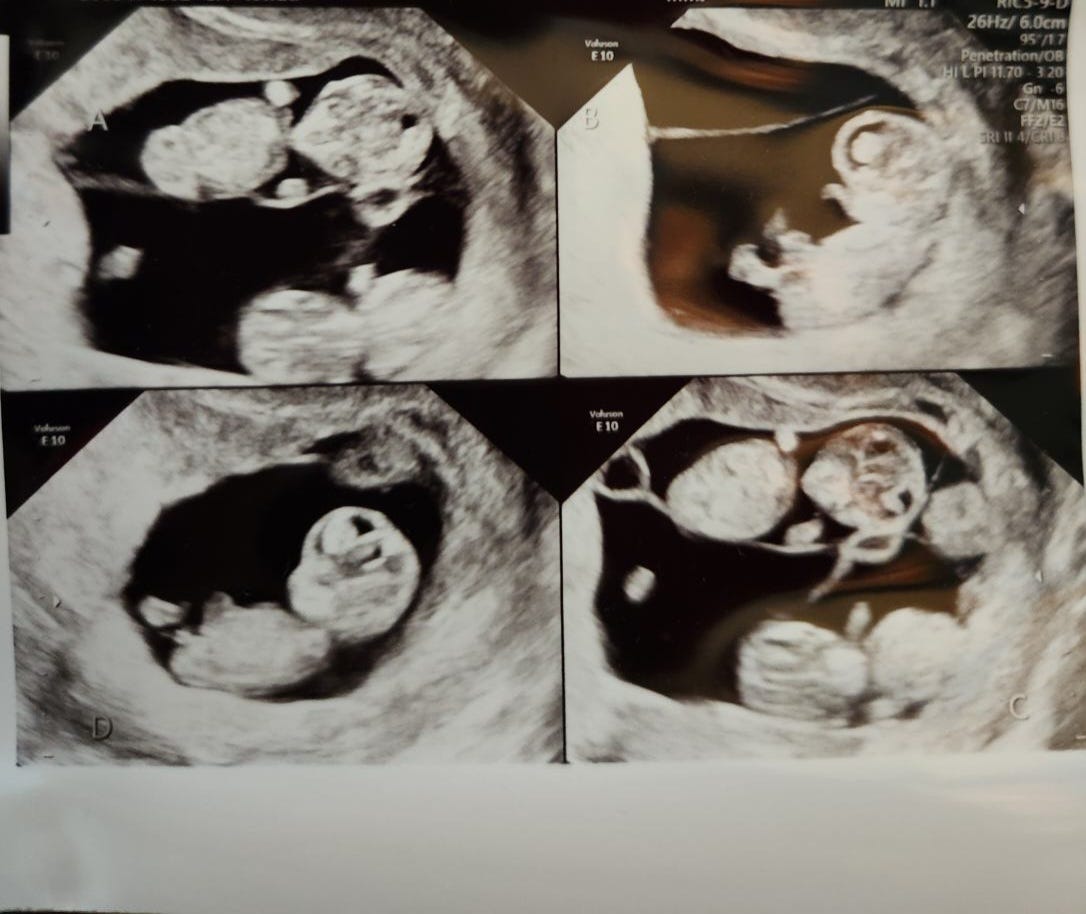 'it's going to be crazy': texas woman celebrates rare birth of identical quadruplets
