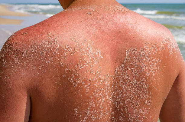 How To Safely Treat Sunburn Peeling