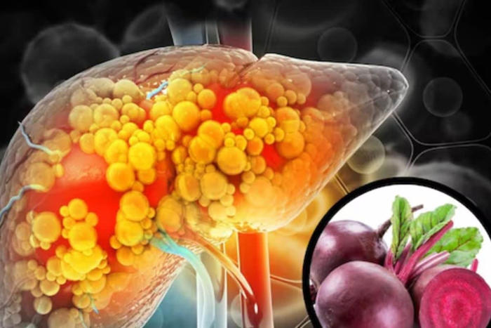 5 foods to consume if you have a fatty liver problem