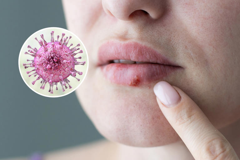 Stock image of a woman with oral herpes (main) and a Cytomegalovirus from Herpesviridae family (inset). Scientists have found a way that herpes breaks into our cells.