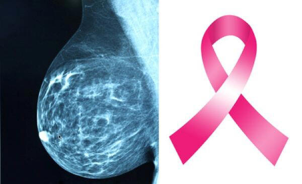 Debate Over Breast Cancer Screening: Age 40 or 50 for Mammograms?