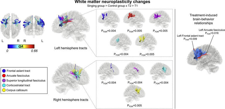 Neuroplasticity study shows how singing rehabilitates speech production ...