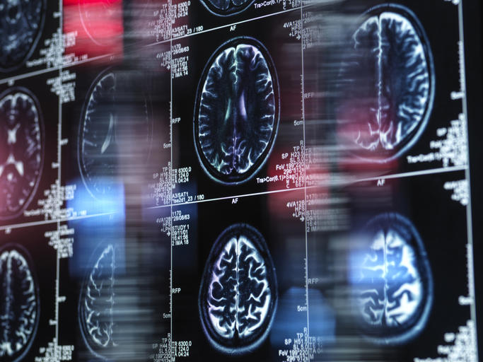 brain diseases are getting worse as the planet gets hotter
