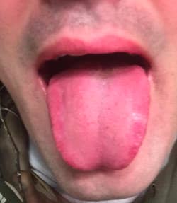 reviewer pic of same user's tongue now clean