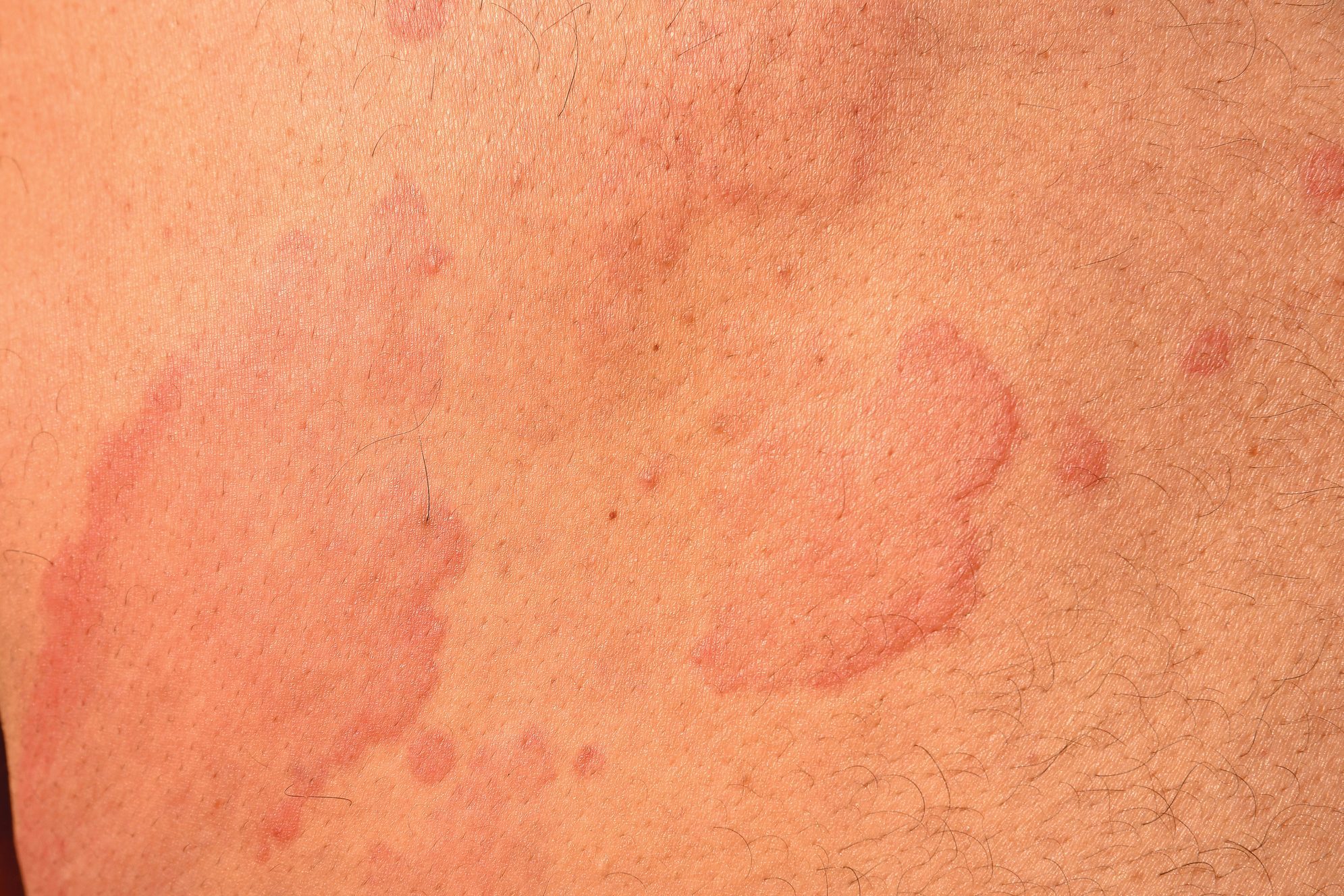 Make Hives Disappear With These Simple Home Remedies