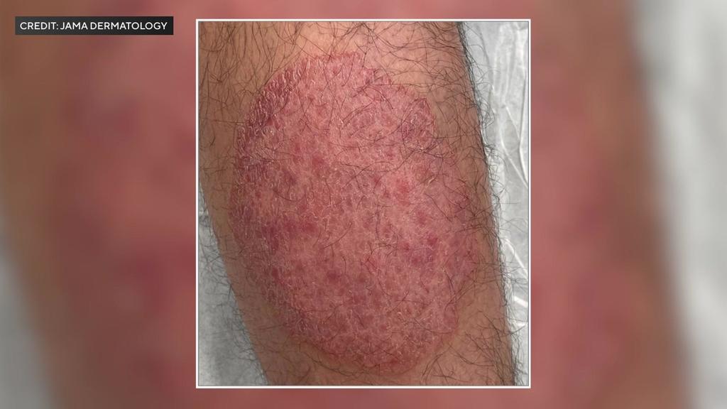 New Sexually Transmitted Form Of Ringworm Reported In NYC. Here's What ...