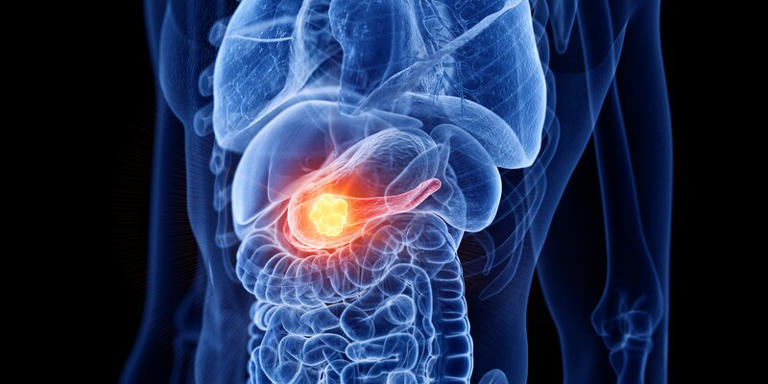 Pancreas cancer, computer illustration. Getty Images/Science Photo Libra