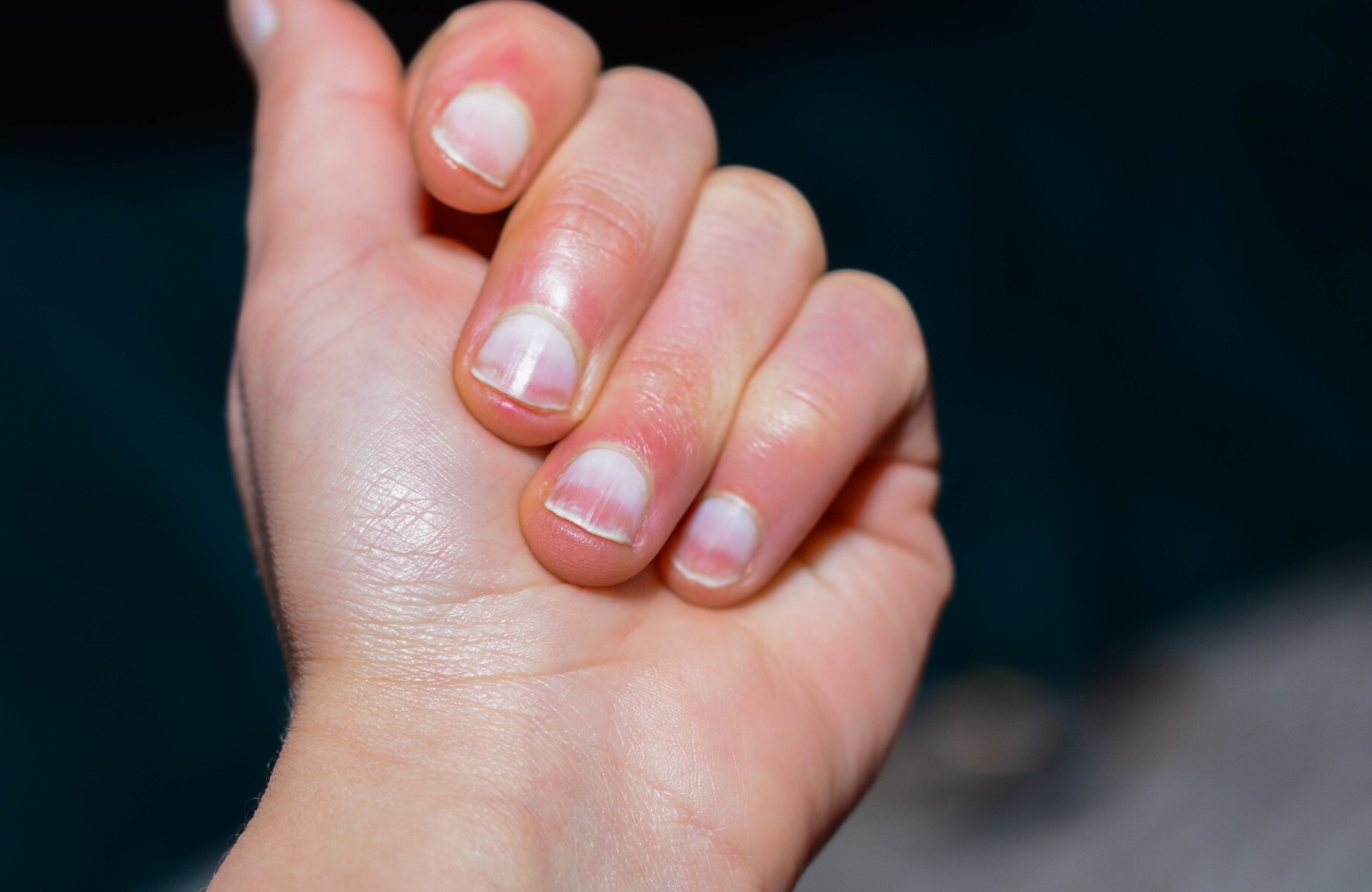 What your nails can tell you about your health