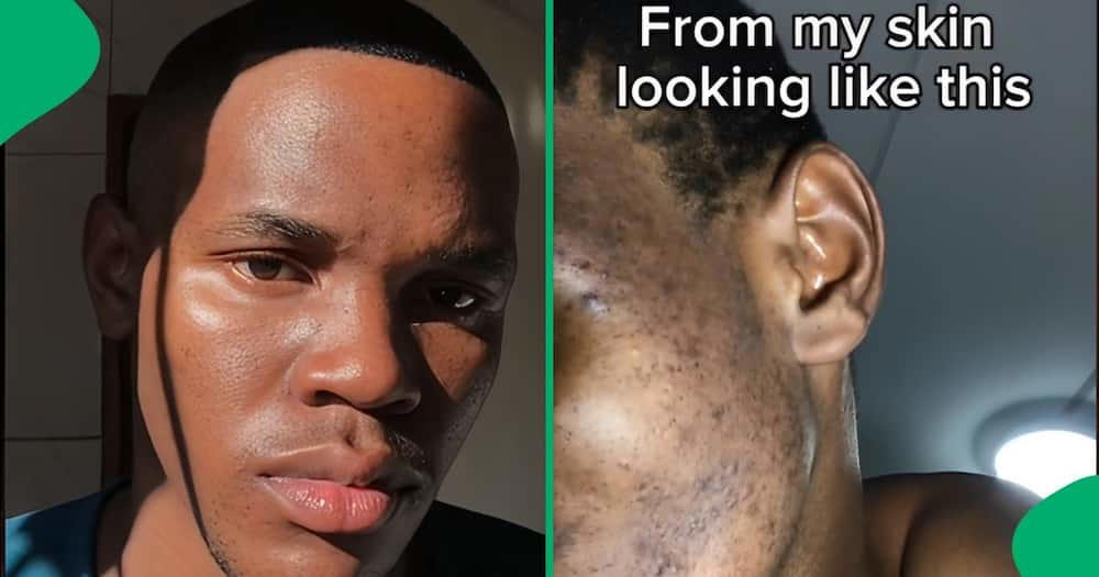 stressing about uneven skin tone?: watch this man's 20-day hyperpigmentation transformation