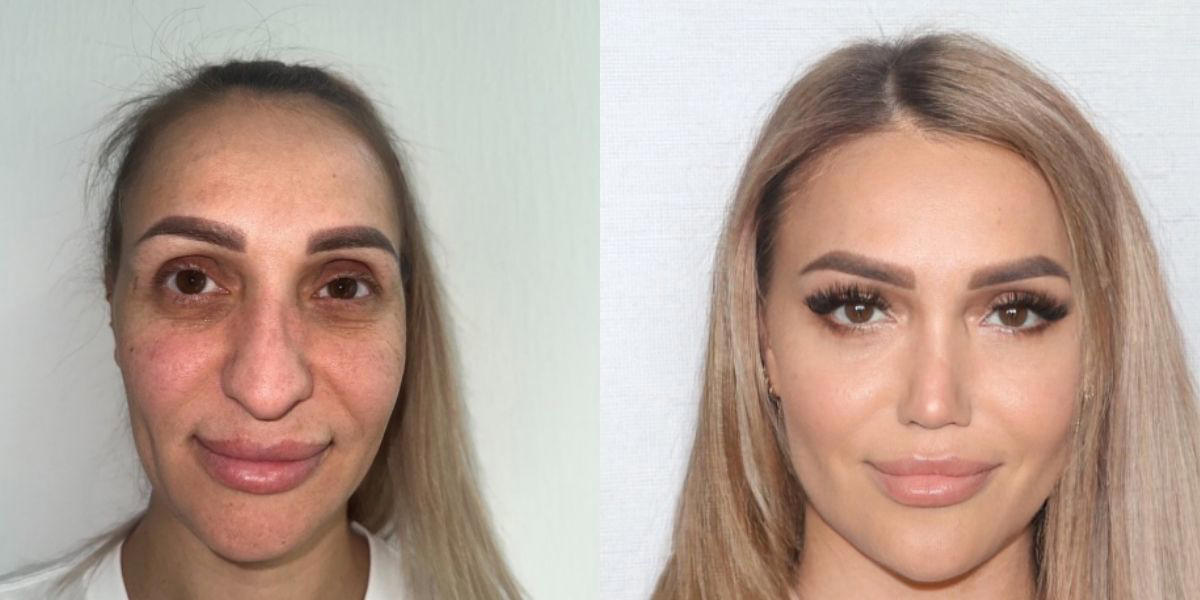 før og efter: kvinde gennemgår drastisk ansigtsmæssig transformation og chokerer netbrugere