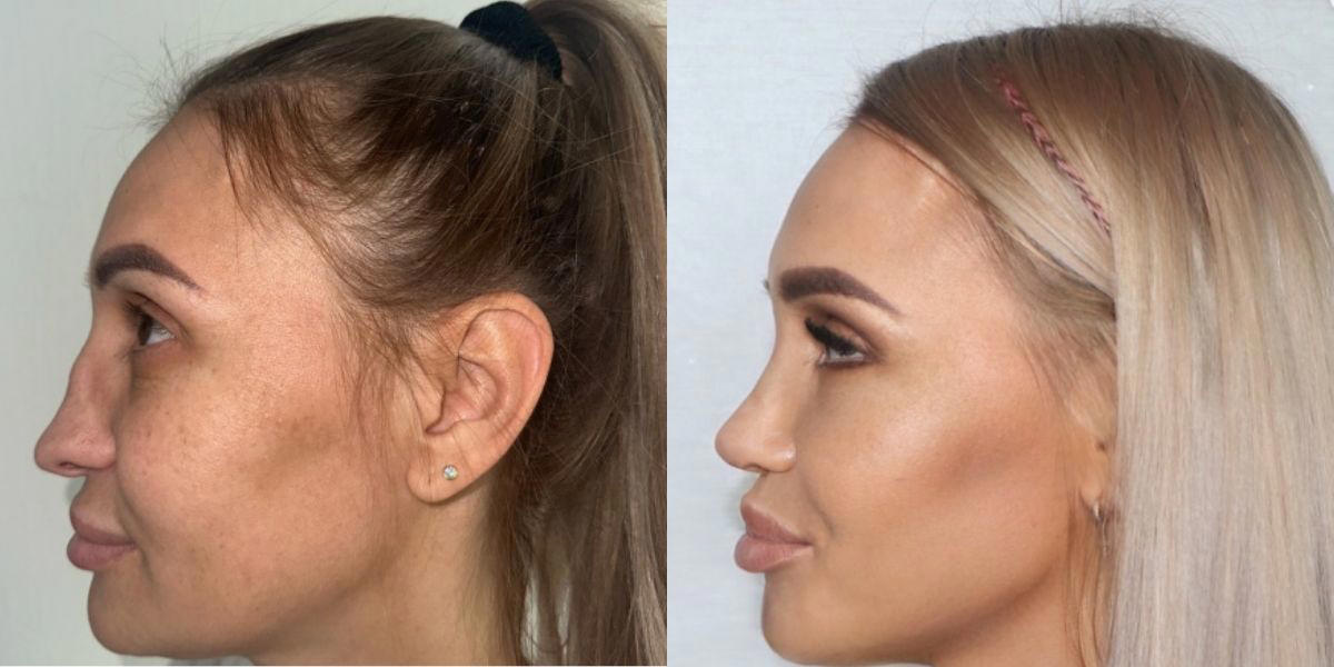 før og efter: kvinde gennemgår drastisk ansigtsmæssig transformation og chokerer netbrugere