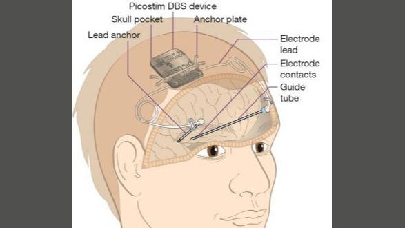 voor het eerst implantaat in hersenen tegen epilepsie: 'patiënt heeft hier veel baat bij'