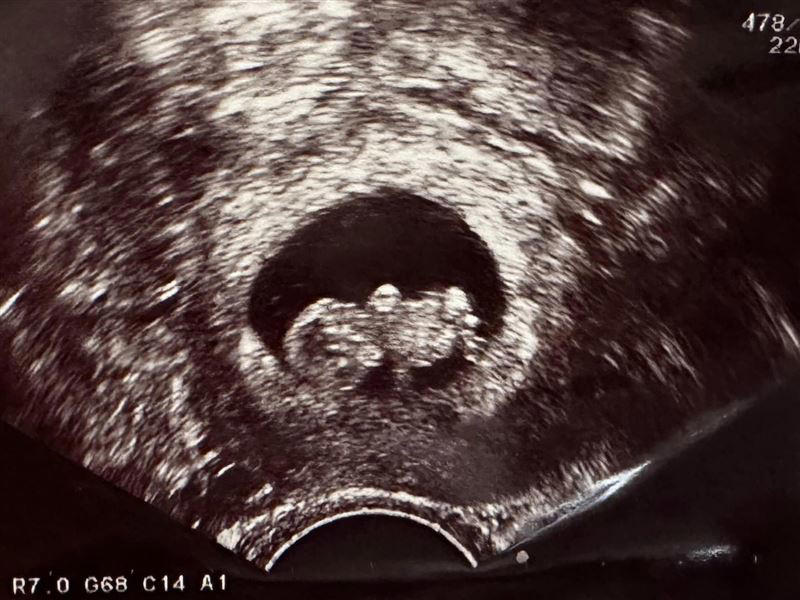 恭喜！41歲李佳穎「宣布懷孕5個月」 煎熬試管過程曝光