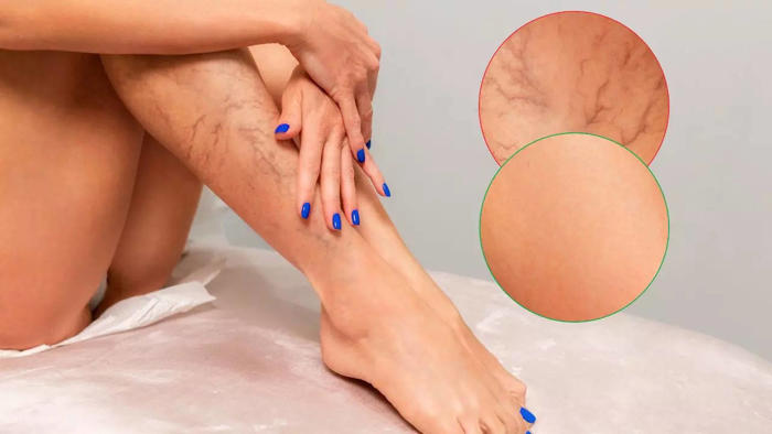 varicose veins causes: doctor shares common habits that can make the condition worse
