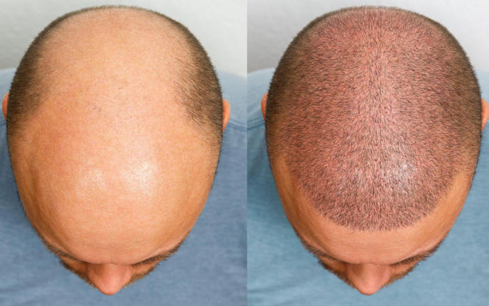 how to, how to know if (and when) you’re going to go bald