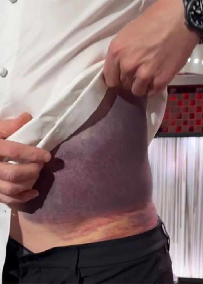'i'm lucky to be standing here': gordon ramsay shows gruesome injuries after near-fatal bike accident