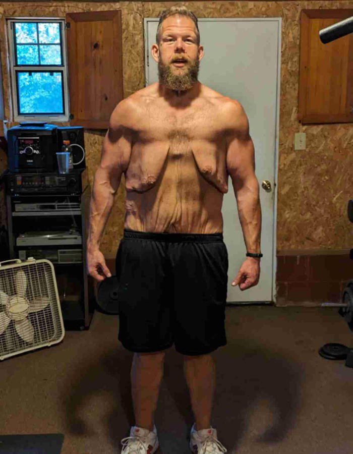 mies taistelee liiallista ihoa vastaan ​​pudonnut 163 kg
