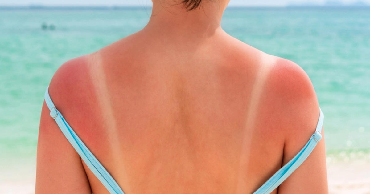 många svenskar undrar: blir man fortfarande brun när man använder solkräm?