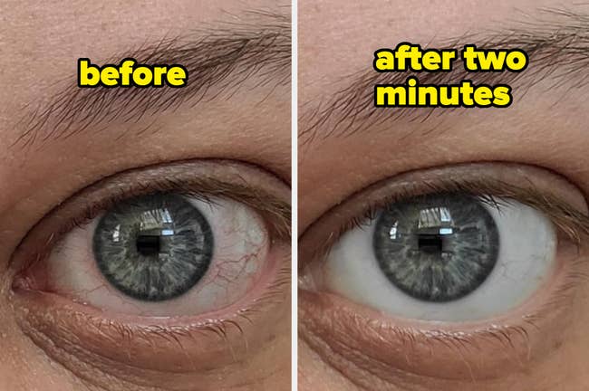 Close-up of a person's eye before using a product reducing redness
