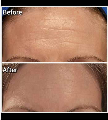 Close-up of a person's forehead showing