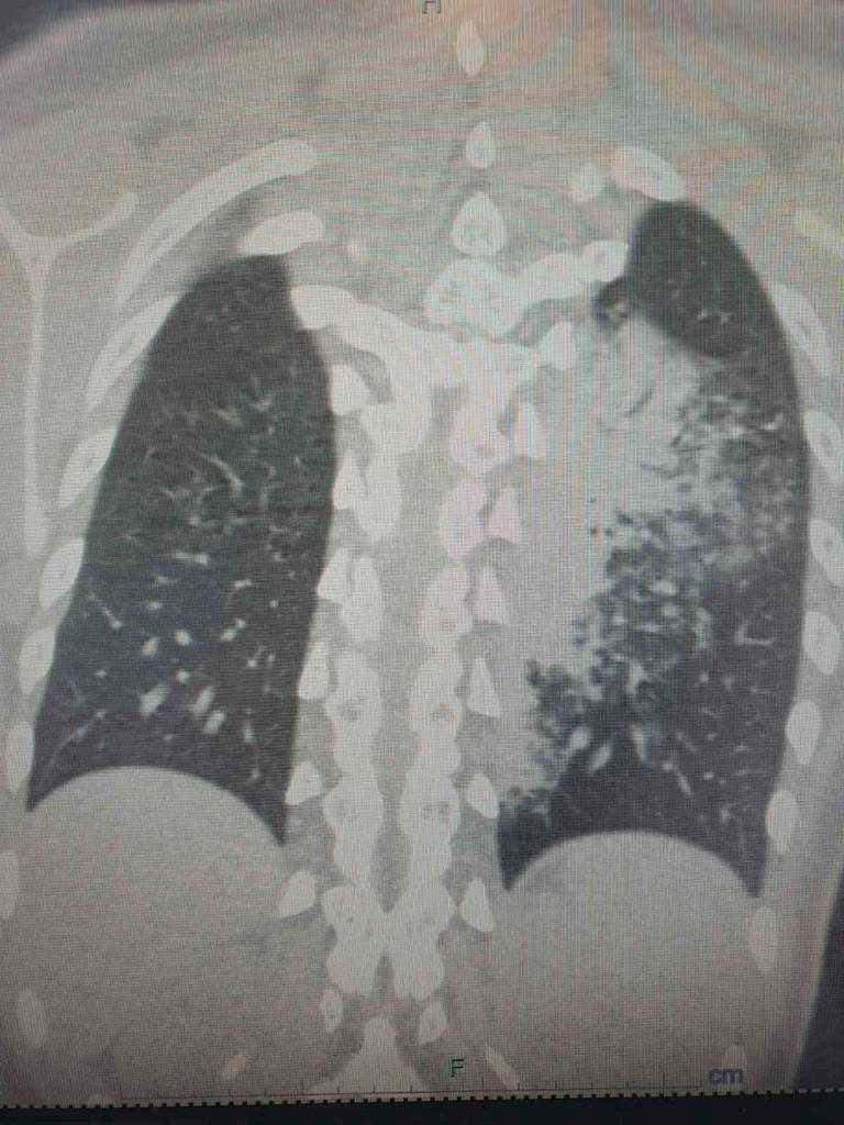 YAZ AYLARININ GELMESİYLE BİRLİKTE KLİMA KULLANIMININ ARTMASI, ÇOCUKLARDA LEJYONER HASTALIĞI OLARAK BİLİNEN LEGİONELLA PNEUMOPHİLA BAKTERİSİ KAYNAKLI ZATÜRRE VAKALARINDA DA ARTIŞA NEDEN OLDU.