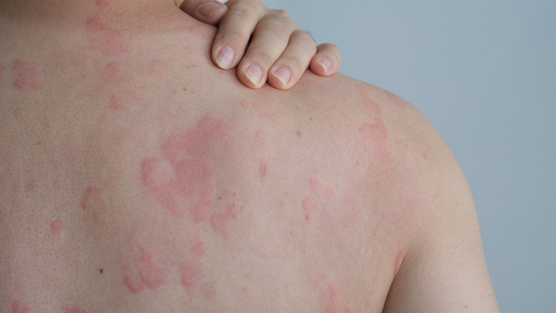 The most effective ways to get rid of hives