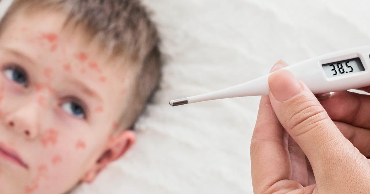 symptoms-linked-to-the-chickenpox