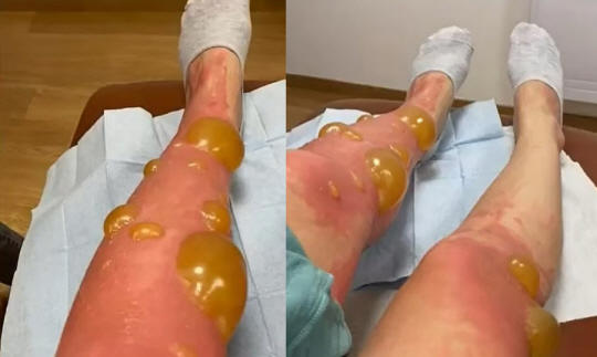 フランスの湖に脚を浸けたら大きい水泡がぼこぼこ…原因は「植物性光皮膚炎」だった