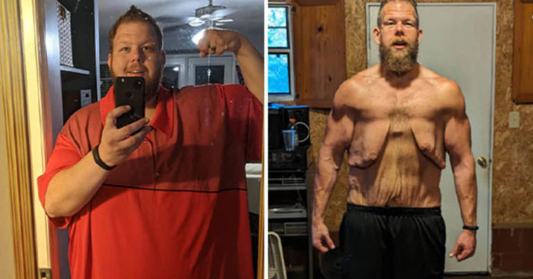 The internet has rallied behind a man who felt “trapped” in excess skin after an inspiring weight-loss transformation. 40-year-old Cole Prochaska reminds us all that it’s never too late to make a change. He used to weigh “as much as three men” but shed weight until he became the size of “one.” But after his […]