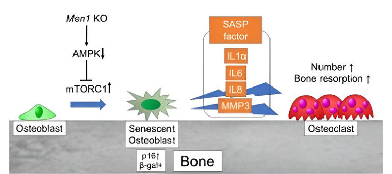 New gene linked to osteoporosis identified