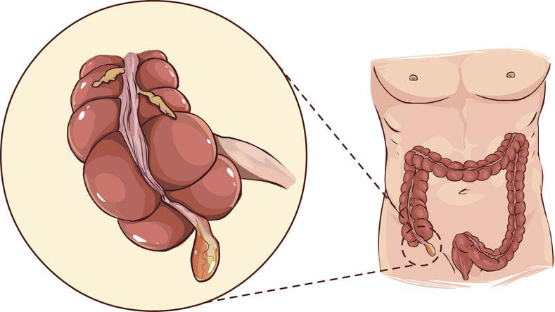 5 causas de la apendicitis que pueden terminar en peritonitis rápidamente