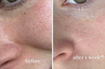 Close-up of a person's cheek before and after one week of skincare treatment, highlighting reduced pores and smoother skin in after image. Text: