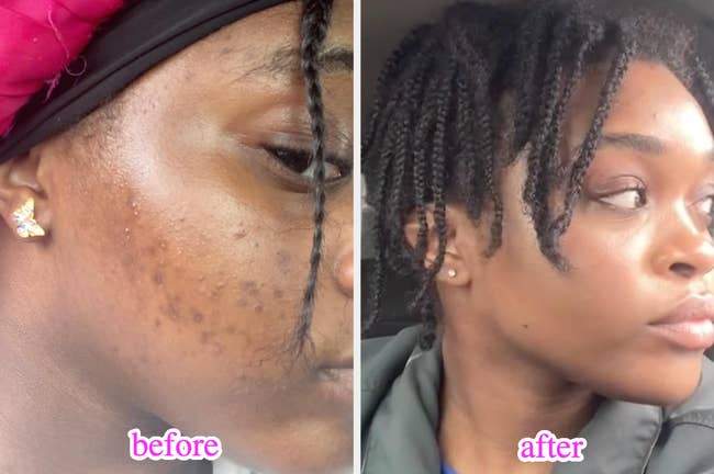 Before and after photos of a reviewer, showing significant improvement in skin clarity and texture. The