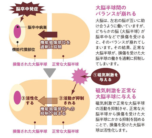 進化したリハビリテーション治療をご紹介！ 「NEURO®」「ボツリヌス療法」​とは