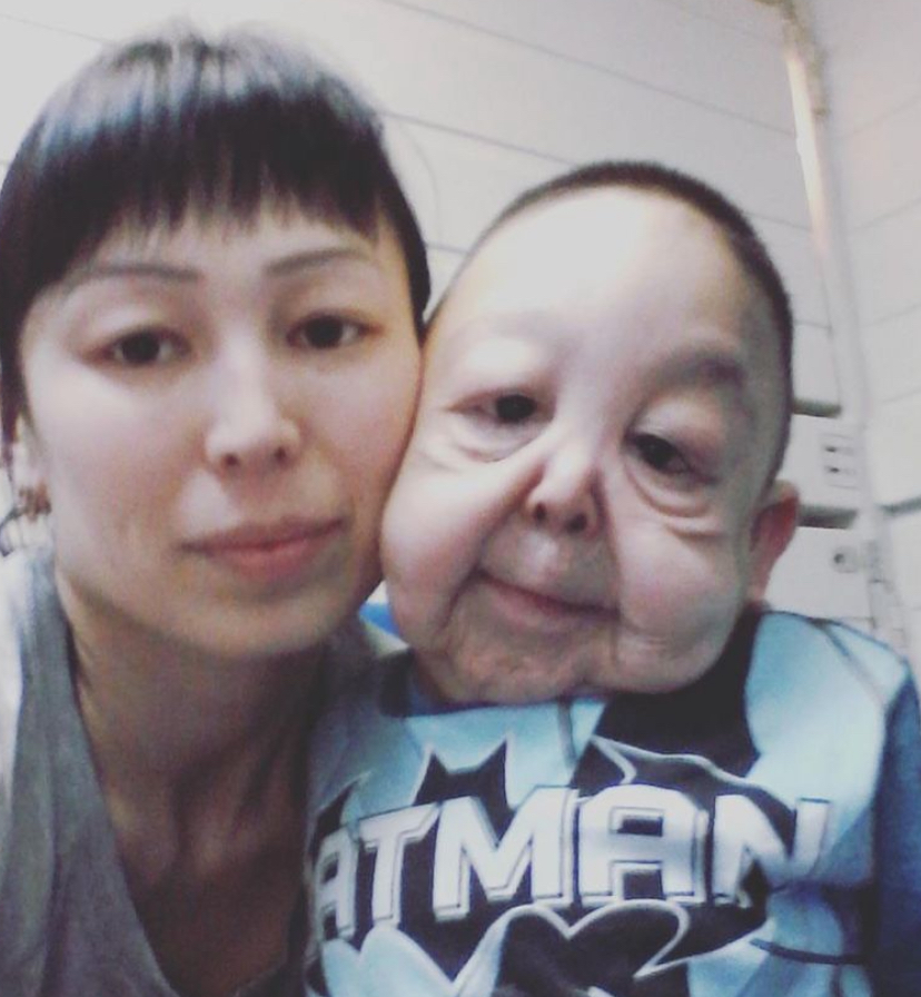 Síndrome rara faz menino de apenas 6 anos ter aparência de idoso