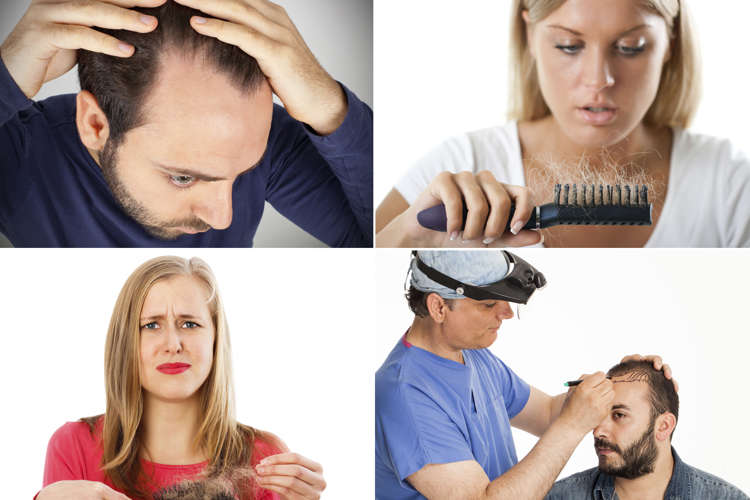 15 Facts About Hair Loss