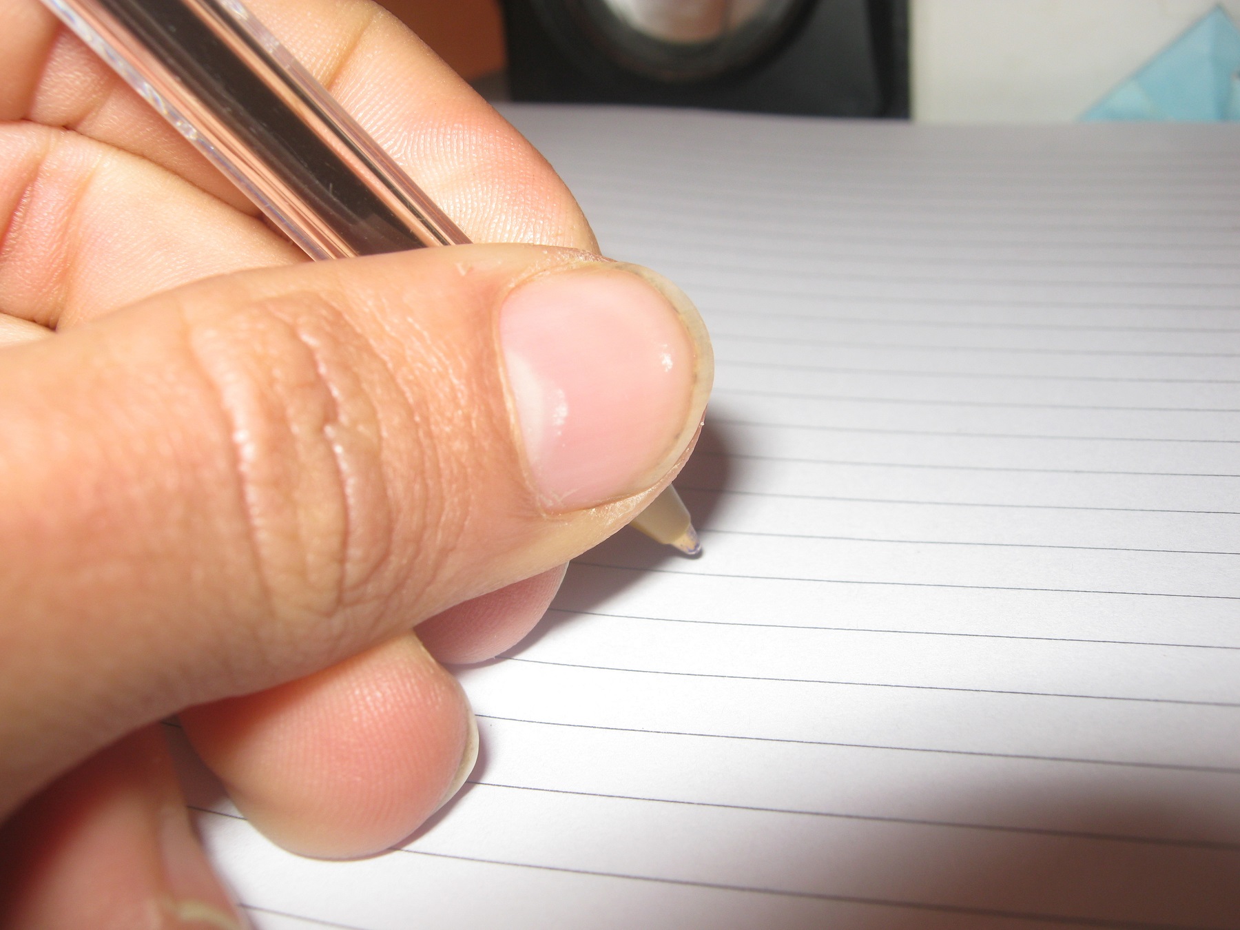 Spoon Shaped Nails Anemia 