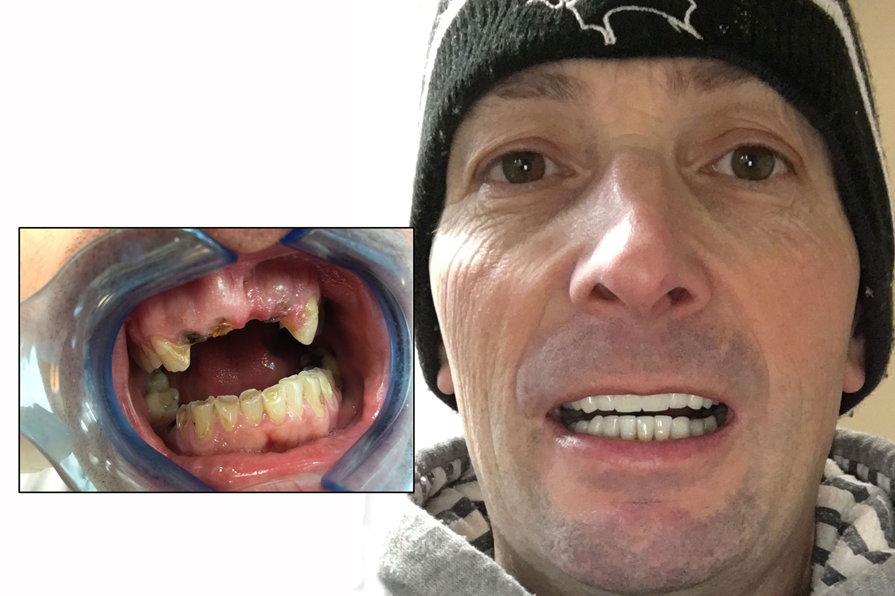 'Bad teeth ruined my confidence but I've finally learnt how to smile'